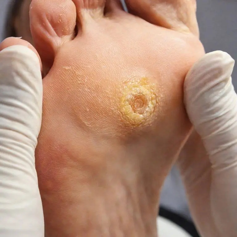 # ŒIL DE POISSON : QUE SE PASSE-T-IL VRAIMENT DANS VOTRE PIED… Voir plus