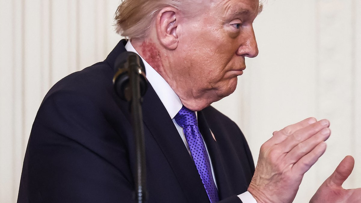Donald Trump malade ? Une éruption cutanée sur son cou causée par « un traitement préventif pour la peau » réitère les spéculations