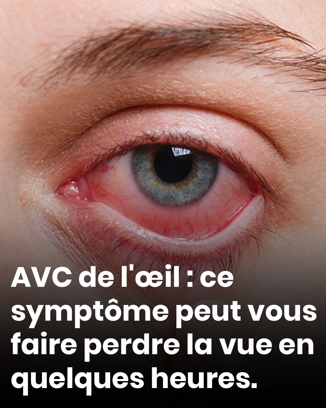 Une baisse soudaine de la vision doit vous conduire aux urgences sans attendre. Lire la suite