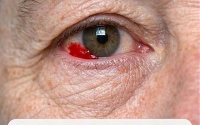 Mon mari de 64 ans s’est réveillé avec une tache rouge et saignante sur l’œil. Devrions-nous aller à l’hôpital ?